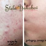 טיפולי פנים עם פילינג קרבון בלייזר סטלה