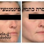 טיפולי פנים עם פילינג קרבון בלייזר סטלה