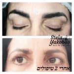 הסרת קעקועים ואיפור קבוע כושל בלייזר סטלה